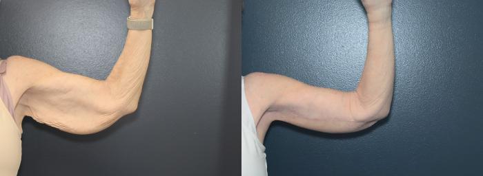 Before & After Arm Lift Case 623 Right Side View in West Des Moines & Ames, IA