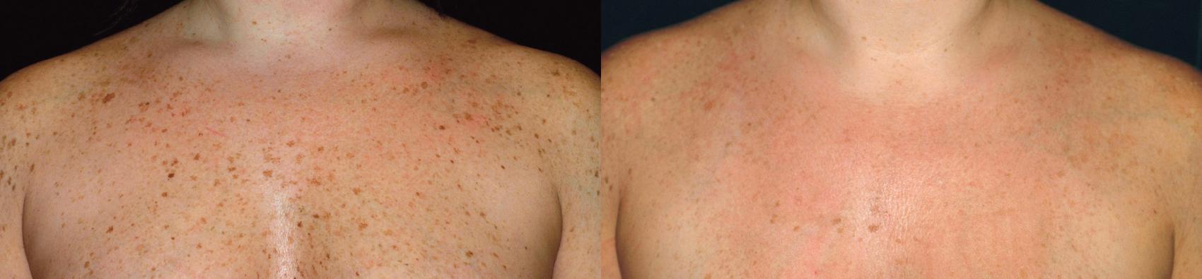 Before & After BBL® Laser Case 205 Front View in West Des Moines & Ames, IA