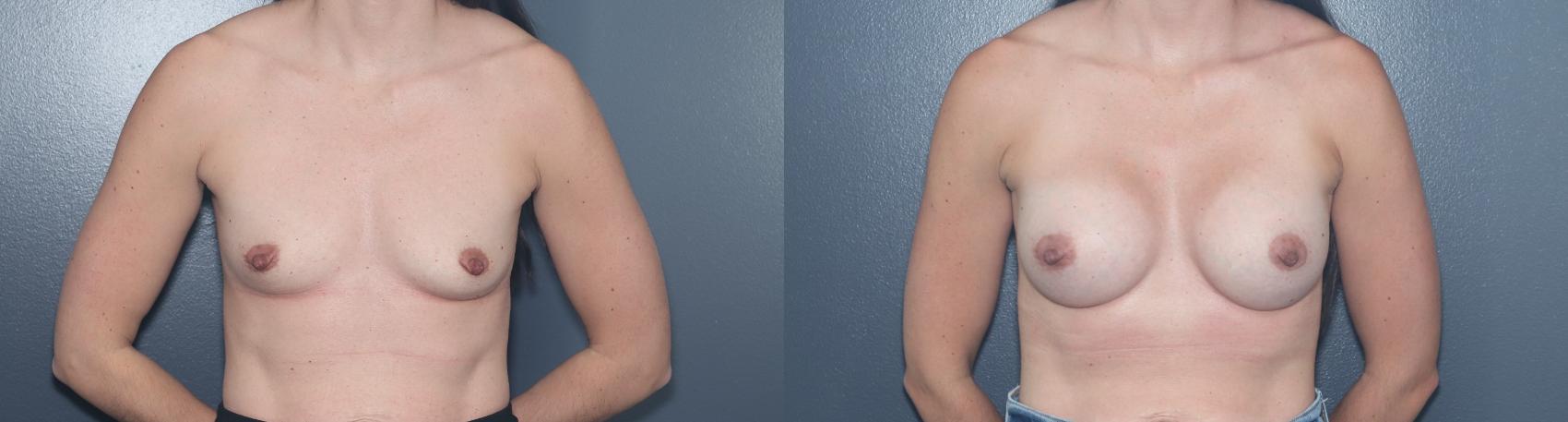 Before & After Breast Augmentation Case 543 Front View in West Des Moines & Ames, IA