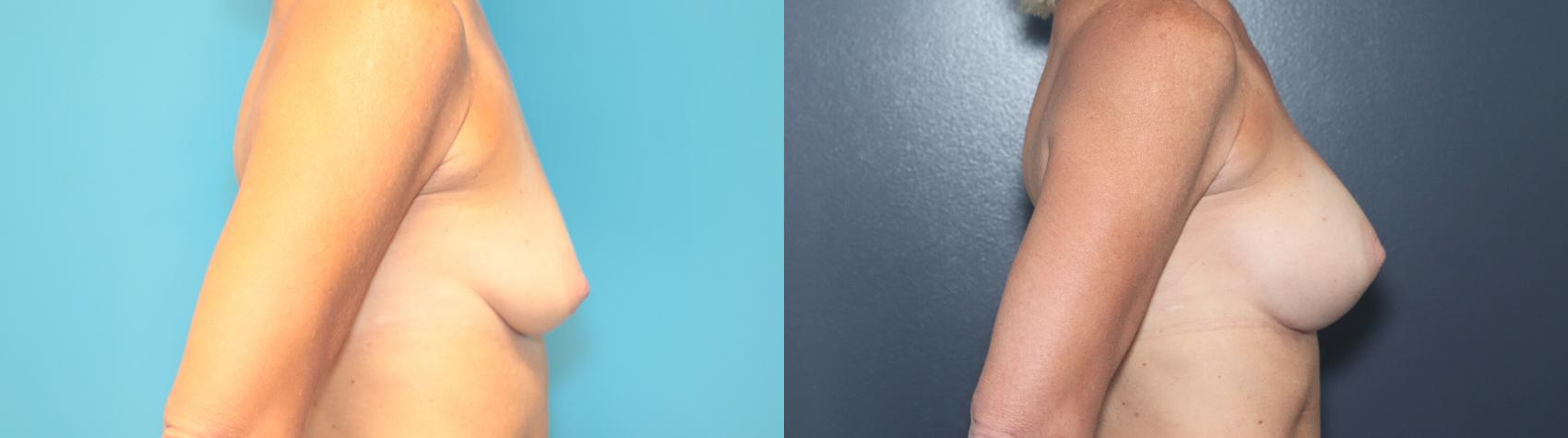 Before & After Breast Augmentation Case 545 Left Side View in West Des Moines & Ames, IA