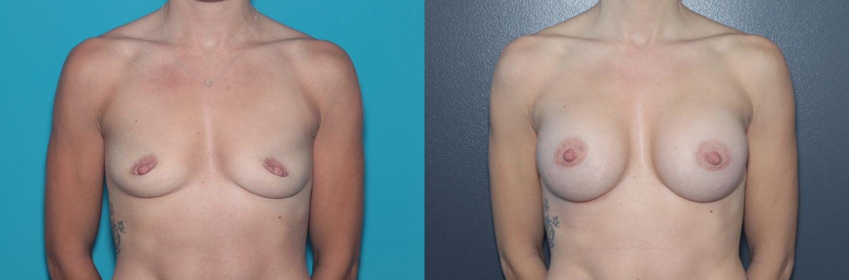Before & After Breast Augmentation Case 547 Front View in West Des Moines & Ames, IA