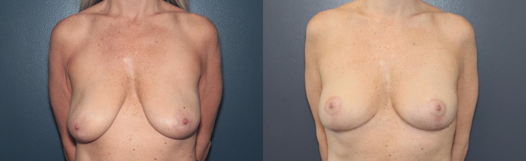 Before & After Breast Lift Case 523 Front View in West Des Moines & Ames, IA