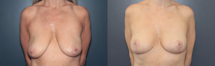 Before & After Breast Lift Case 523 Front View in West Des Moines & Ames, IA