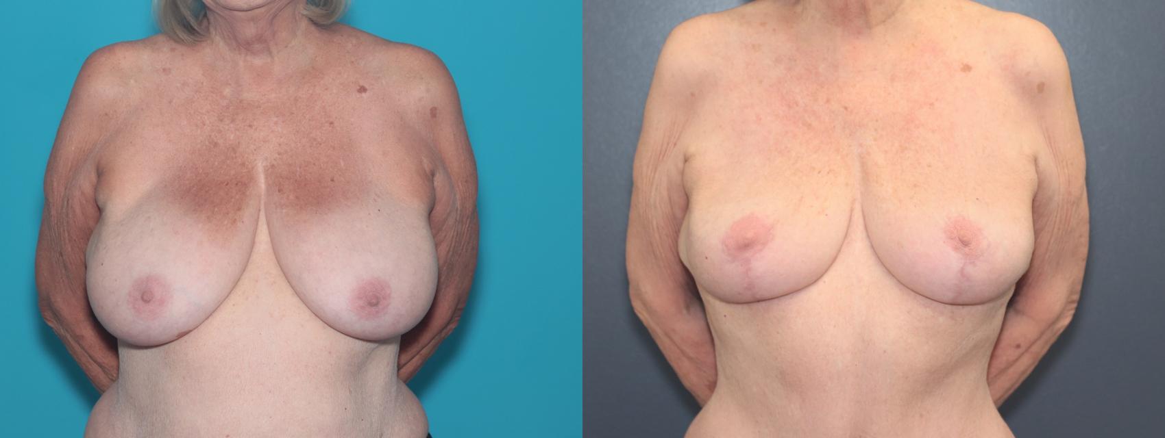 Before & After Breast Lift Case 525 Front View in West Des Moines & Ames, IA