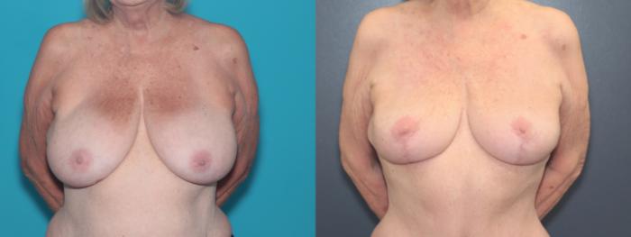 Before & After Breast Lift Case 525 Front View in West Des Moines & Ames, IA
