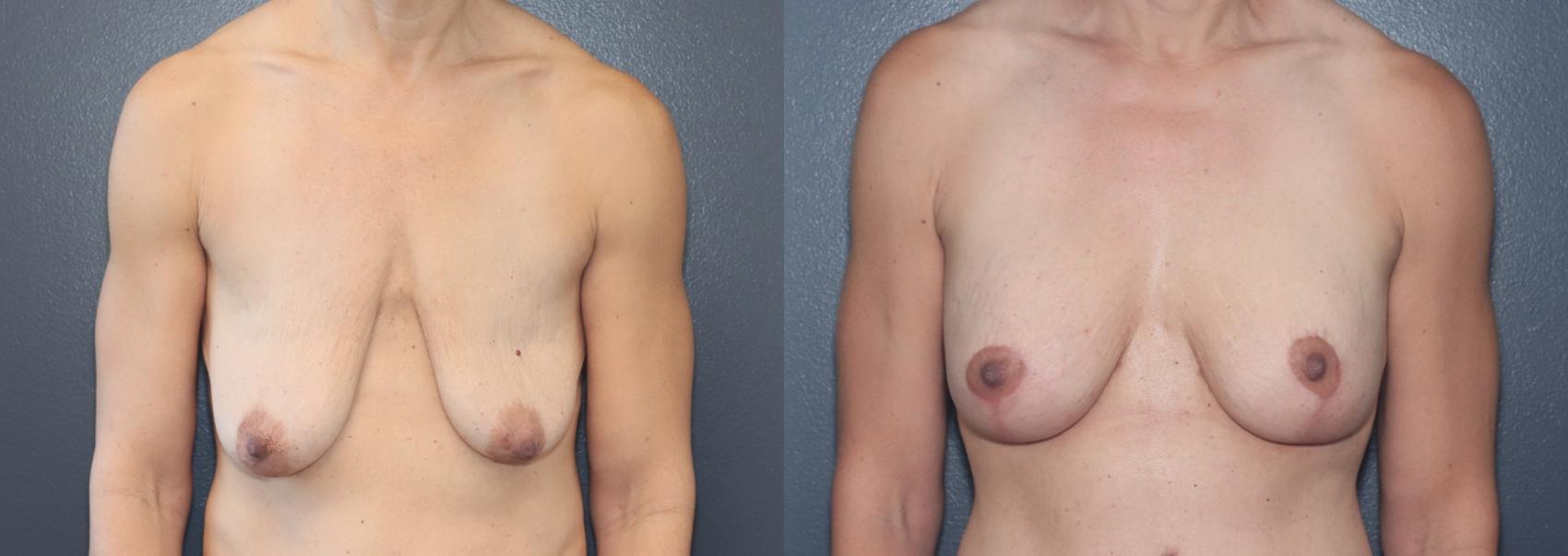 Before & After Breast Lift Case 540 Front View in West Des Moines & Ames, IA