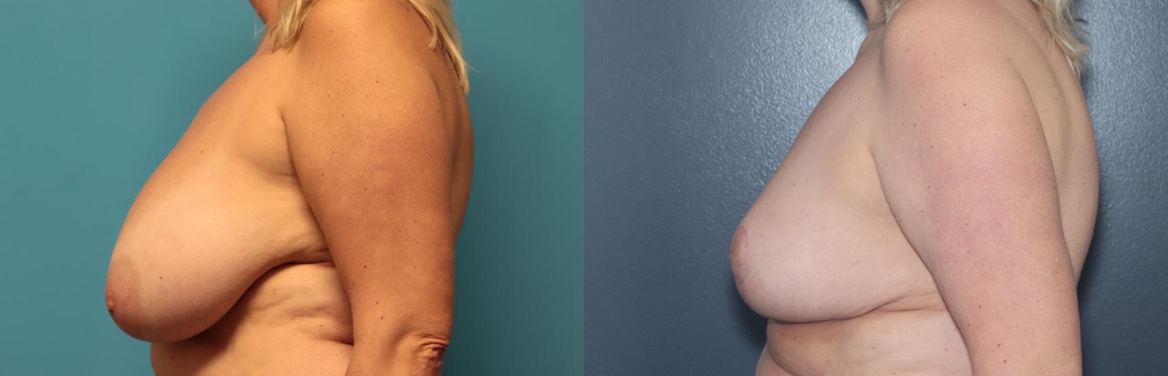 Before & After Breast Reduction Case 542 Right Side View in West Des Moines & Ames, IA