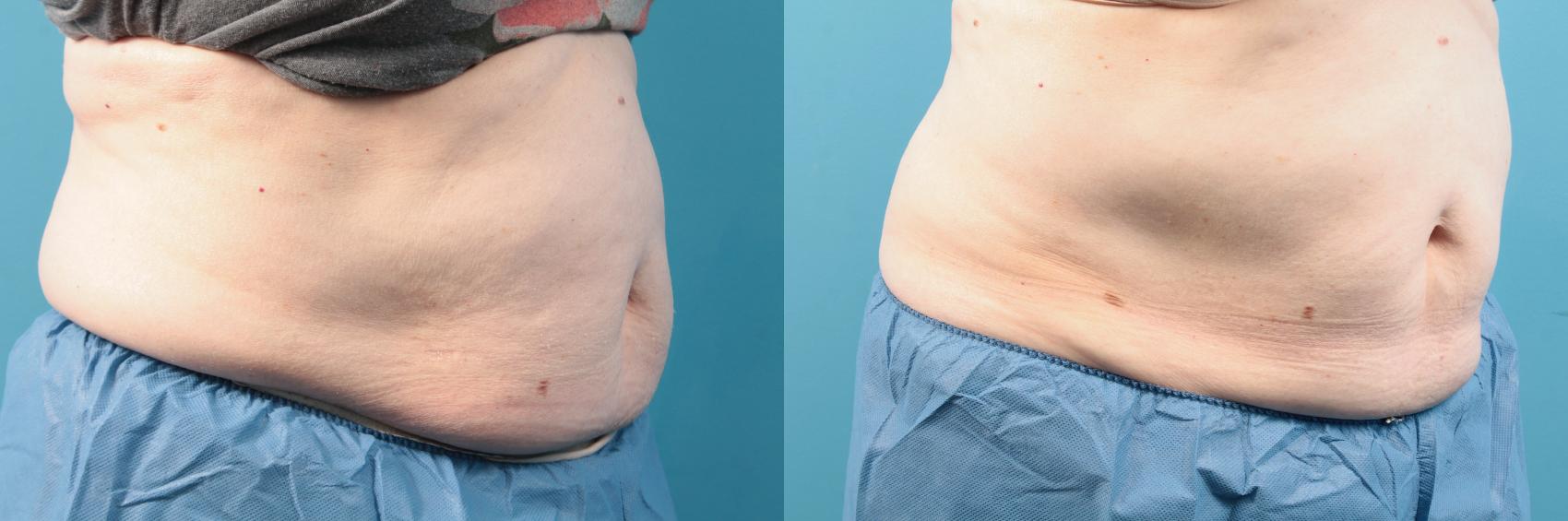 Before & After CoolSculpting® Case 87 View #1 View in West Des Moines & Ames, IA