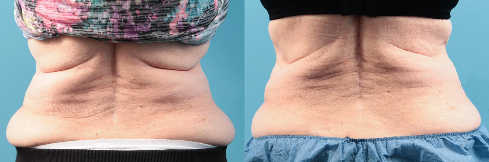 Before & After CoolSculpting® Case 92 View #1 View in West Des Moines & Ames, IA