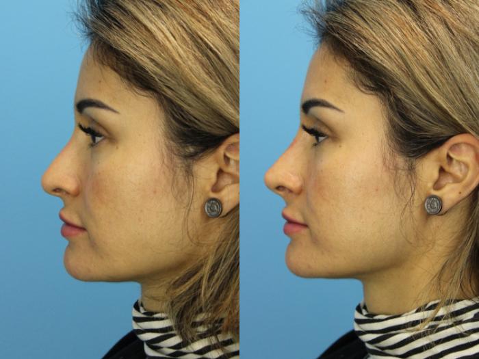 Before & After Dermal Fillers Case 576 Left Side View in West Des Moines & Ames, IA