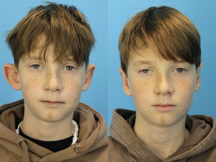 Before & After Ear Surgery Case 579 Front View in West Des Moines & Ames, IA