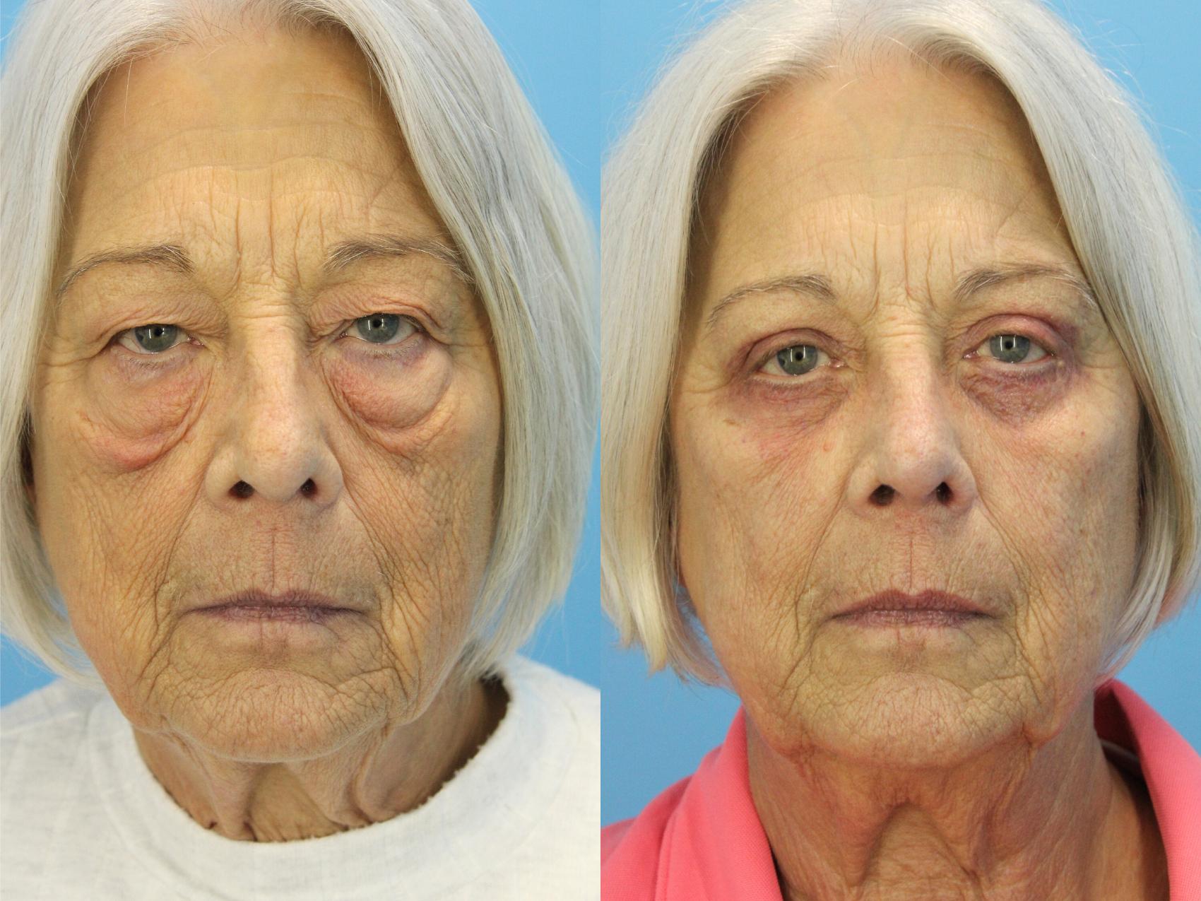 Before & After Eyelid Surgery (Lower, Under Eyes) Case 532 Front View in West Des Moines & Ames, IA