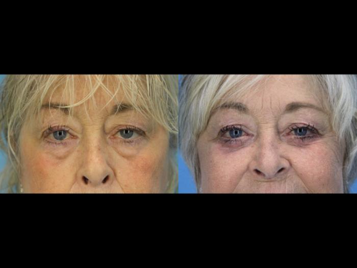 Before & After Eyelid Surgery (Lower, Under Eyes) Case 640 Front View in West Des Moines & Ames, IA