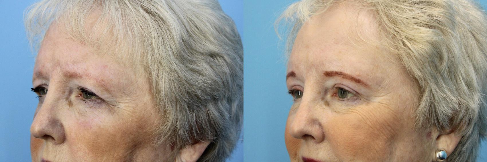 Before & After Eyelid Surgery (Upper Eyelid Lift) Case 527 Left Side View in West Des Moines & Ames, IA