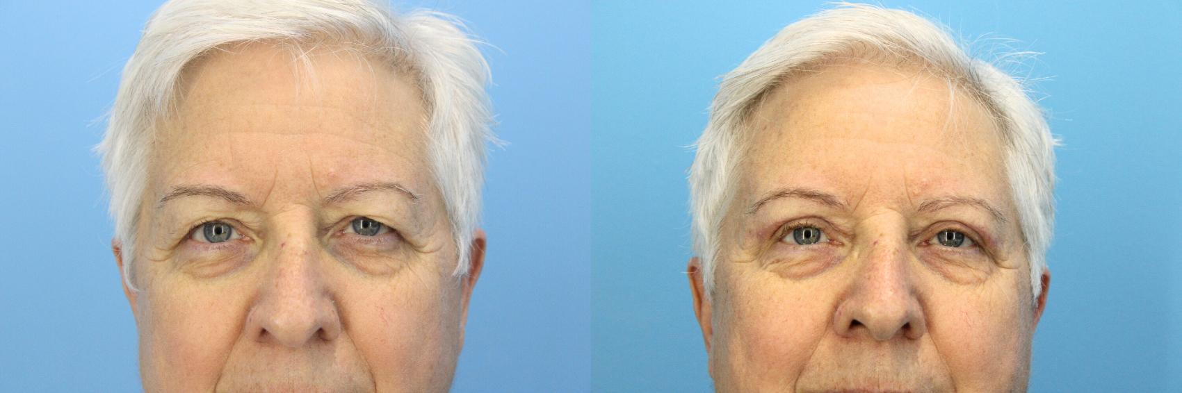 Before & After Eyelid Surgery (Upper Eyelid Lift) Case 533 Front View in West Des Moines & Ames, IA