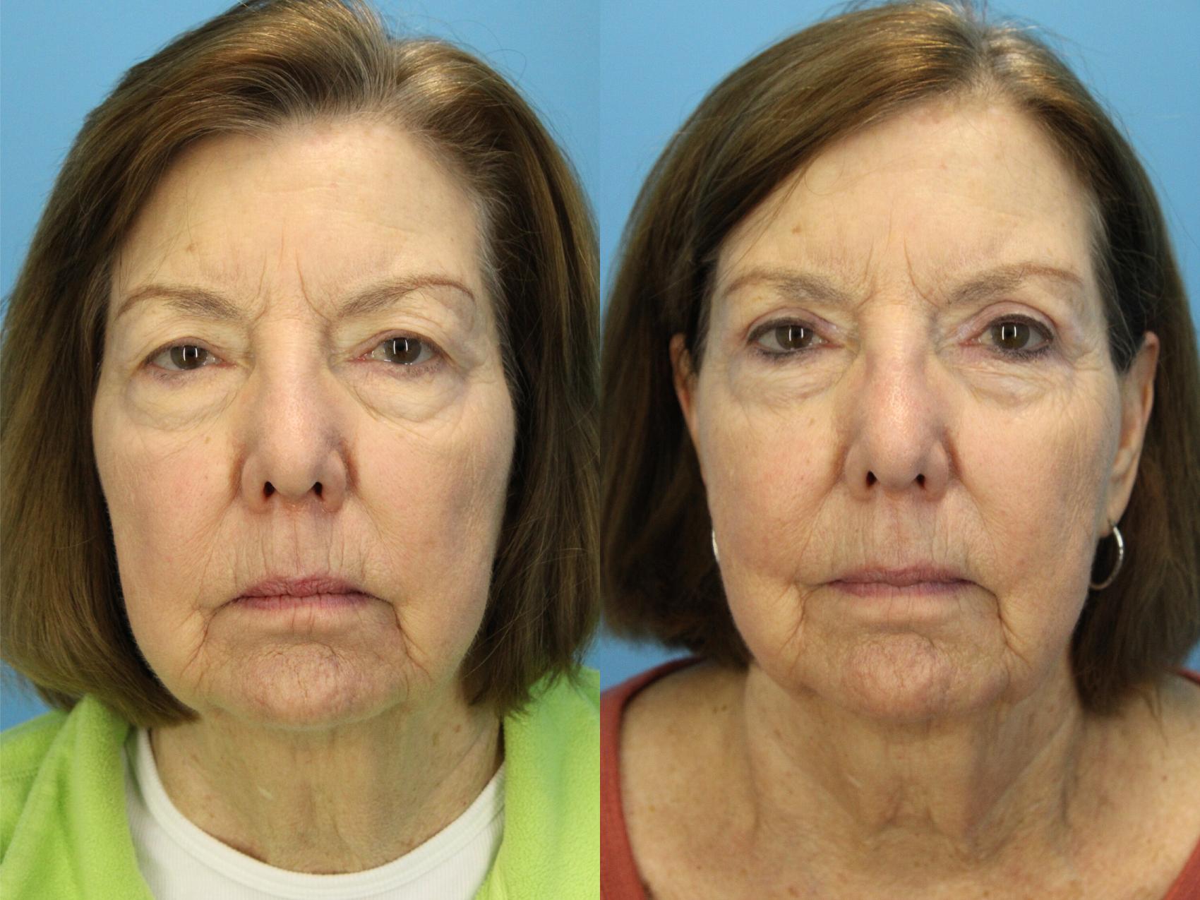 Before & After Eyelid Surgery (Upper Eyelid Lift) Case 564 Front View in West Des Moines & Ames, IA