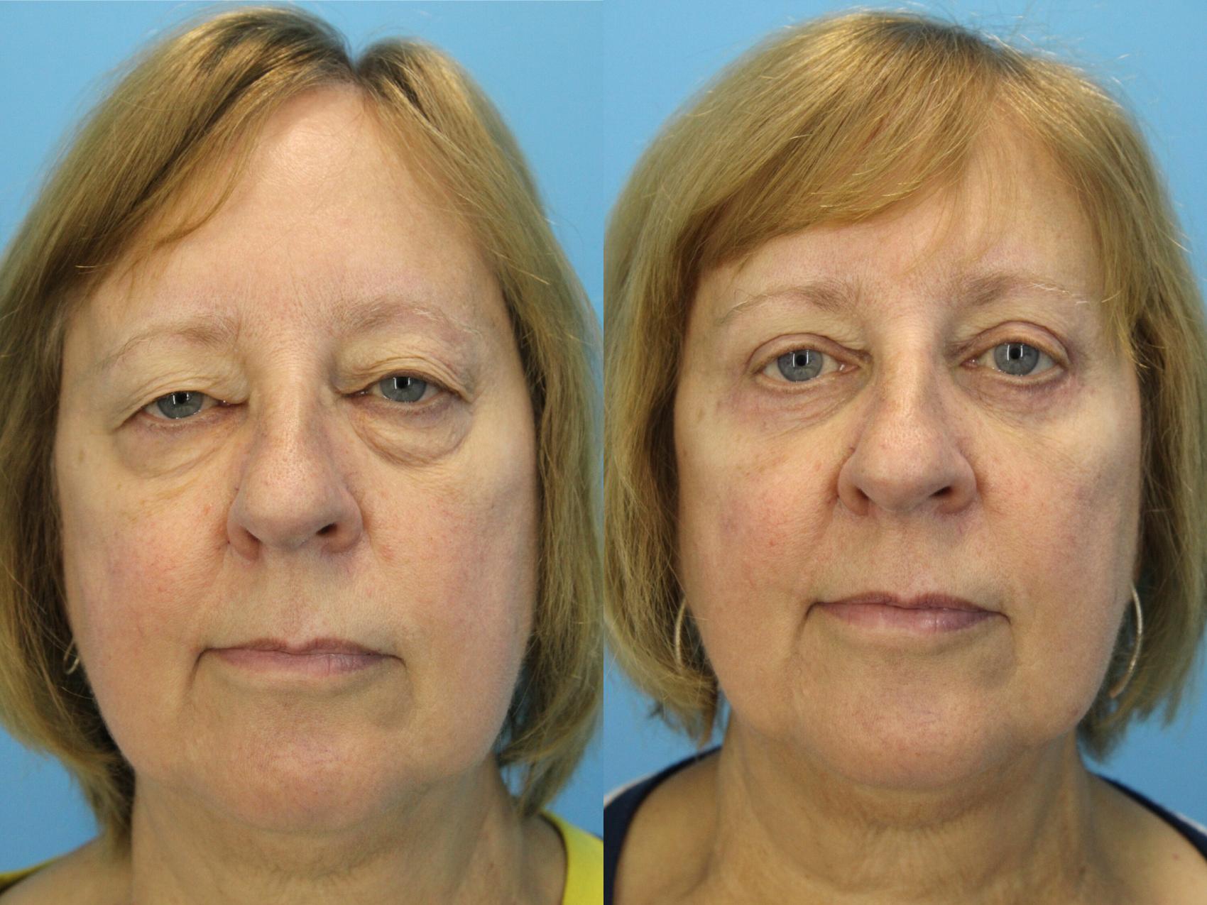 Before & After Eyelid Surgery (Upper Eyelid Lift) Case 566 Front View in West Des Moines & Ames, IA