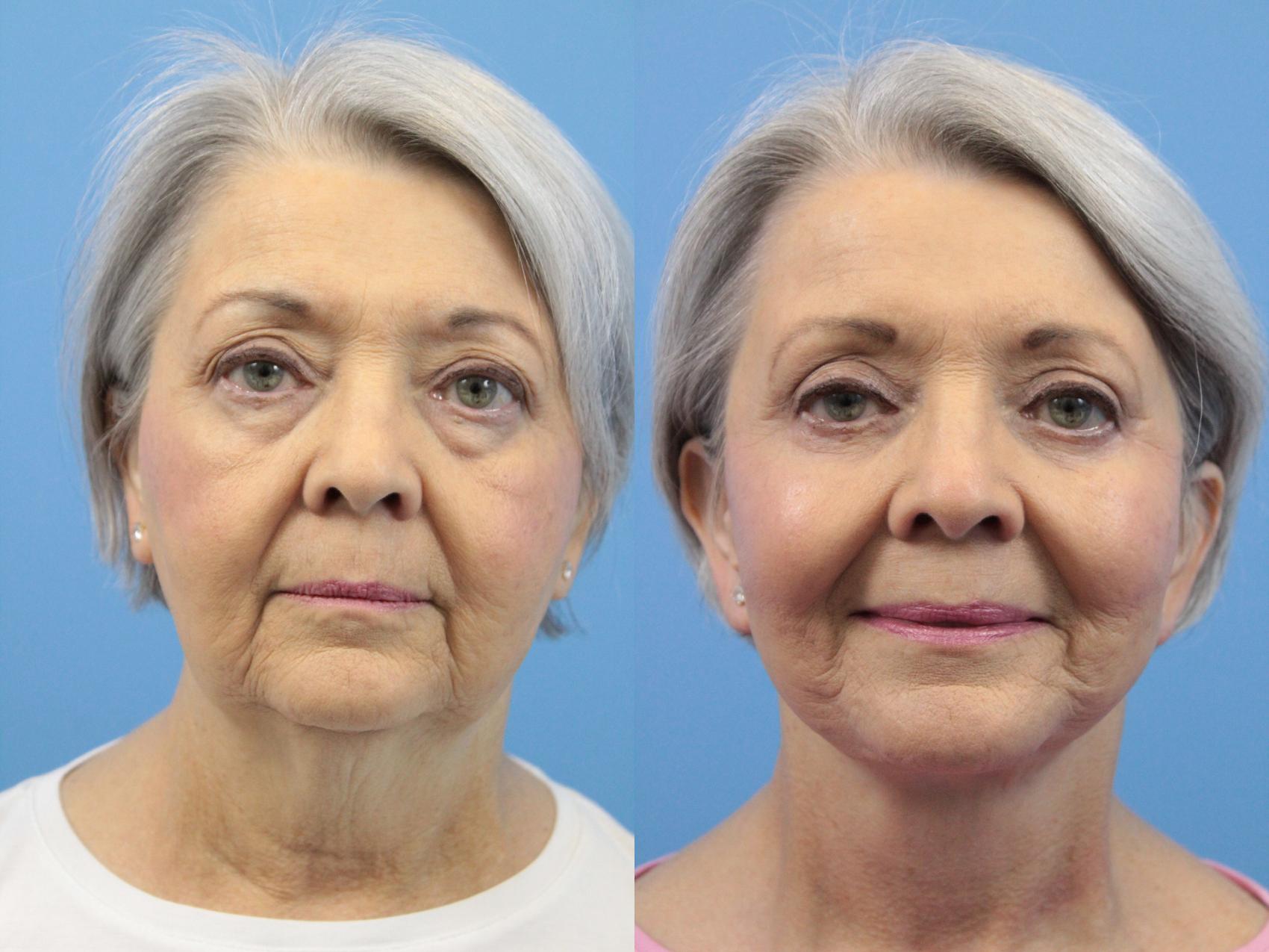 Before & After Facelift Case 141 View #1 View in West Des Moines & Ames, IA