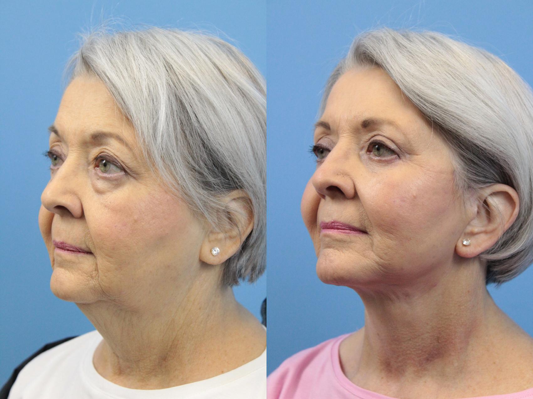 Before & After Facelift Case 141 View #2 View in West Des Moines & Ames, IA