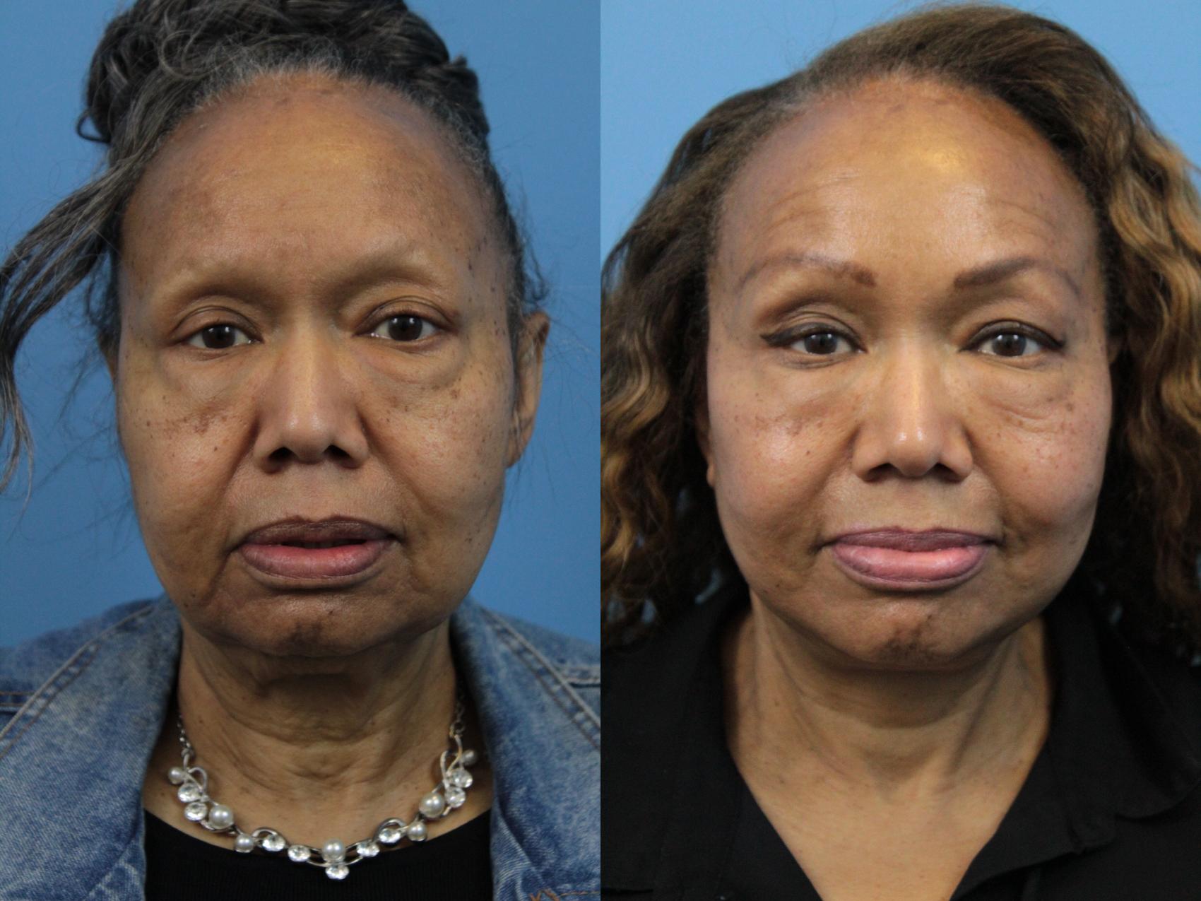 Before & After Facelift Case 187 View #1 View in West Des Moines & Ames, IA