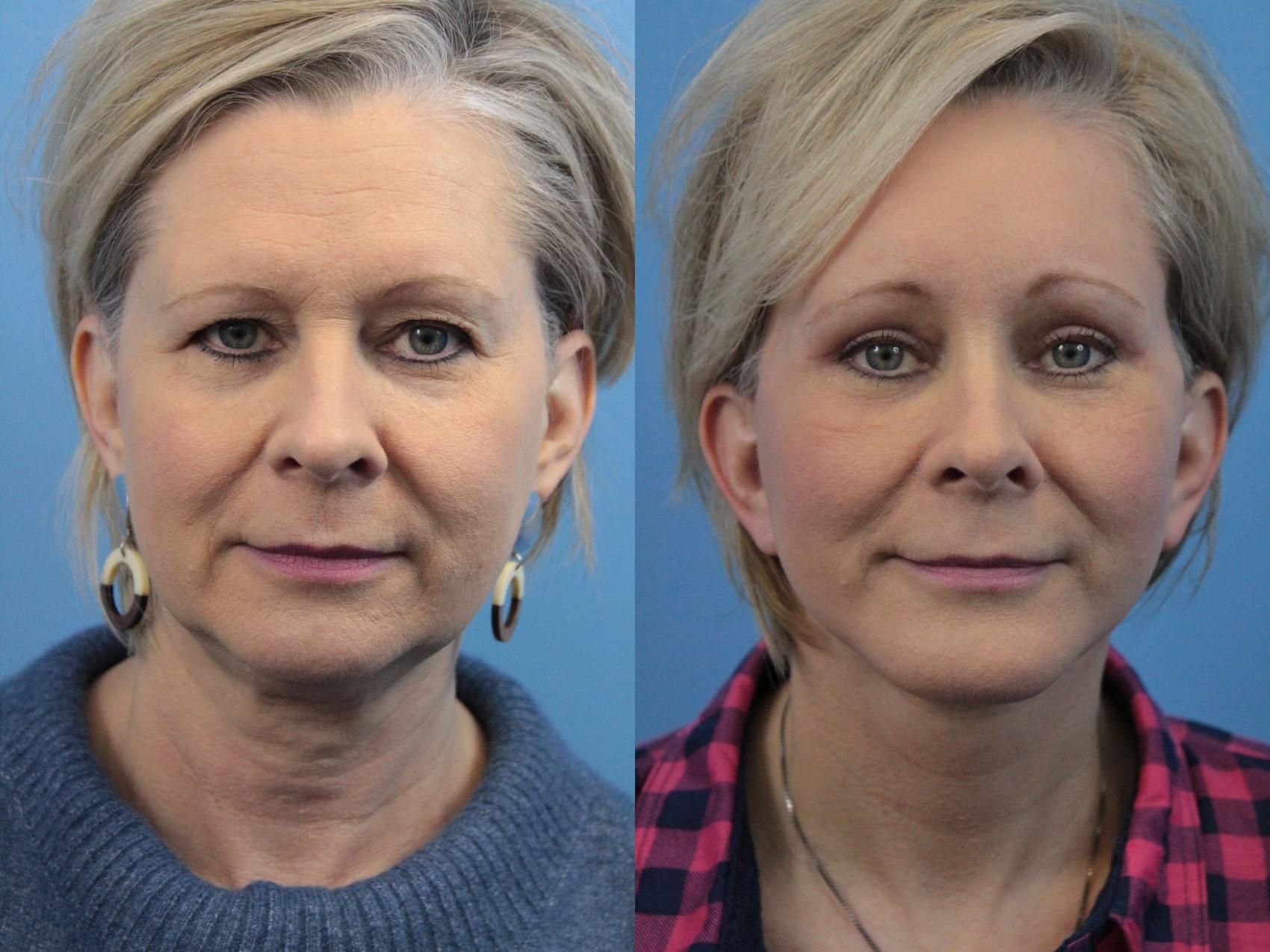 Before & After Facelift Case 207 Front View in West Des Moines & Ames, IA