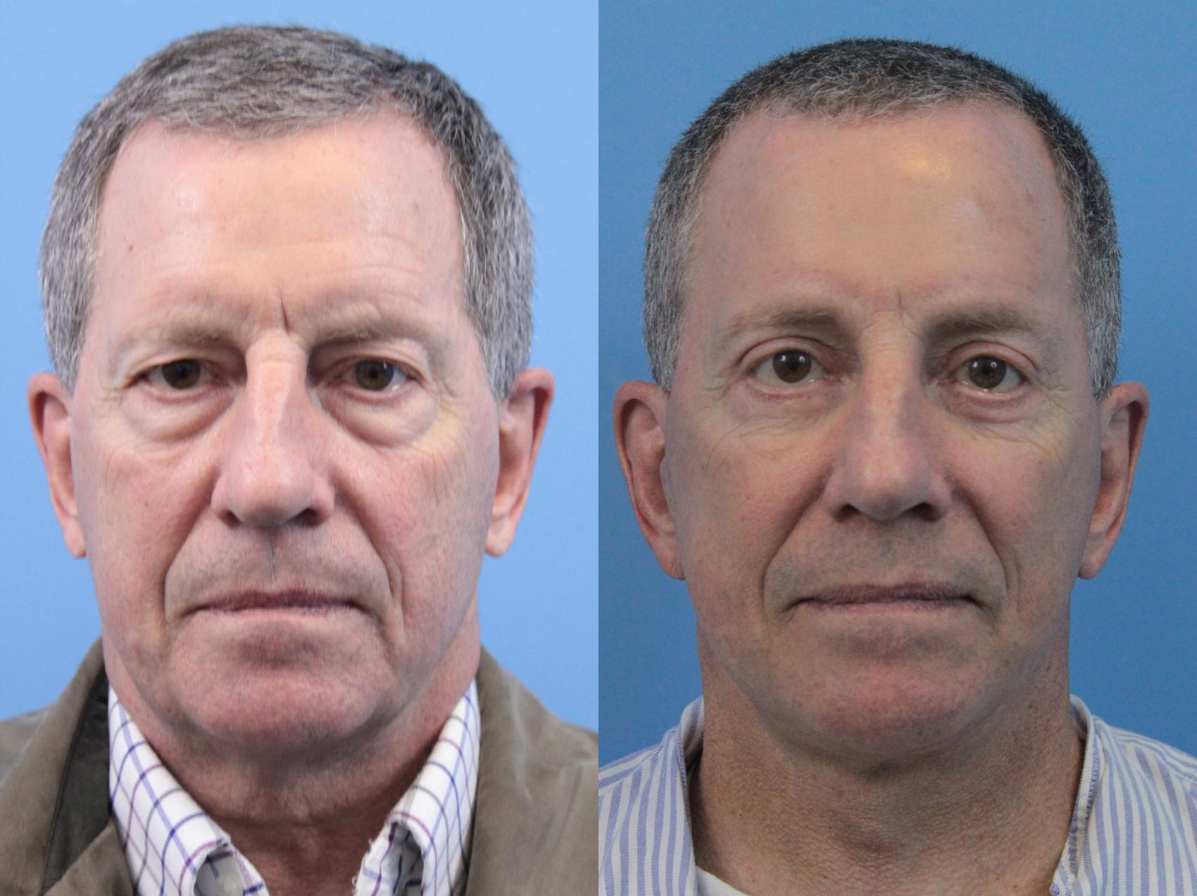 Before & After Facelift Case 208 Front View in West Des Moines & Ames, IA