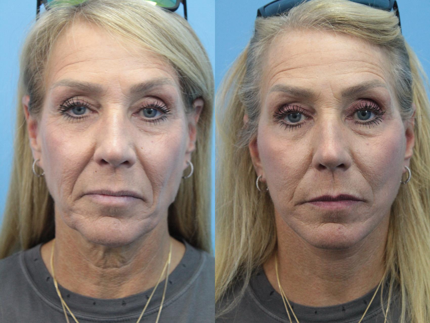 Before & After Facelift Case 358 Front View in West Des Moines & Ames, IA