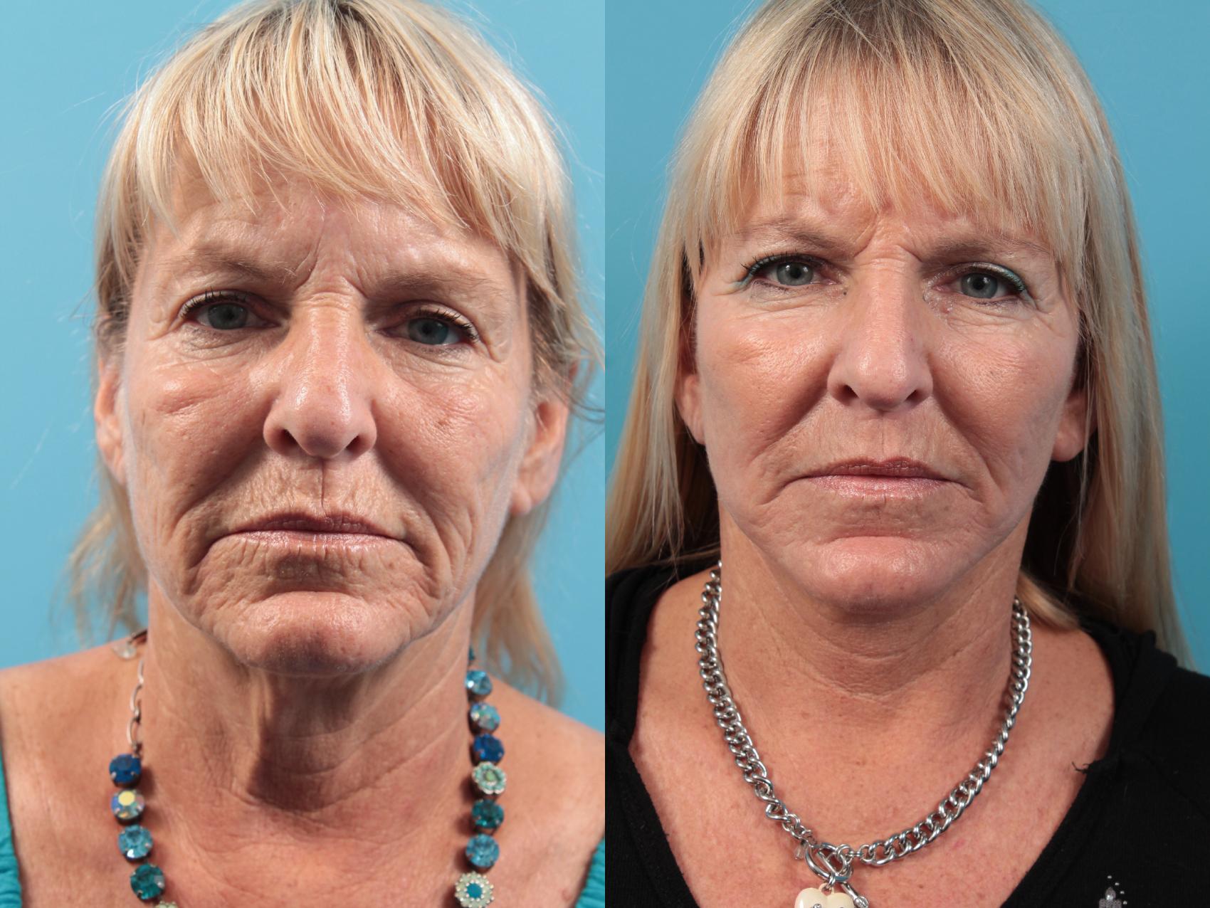 Facelift Before And After Pictures Case West Des Moines Ia Koch