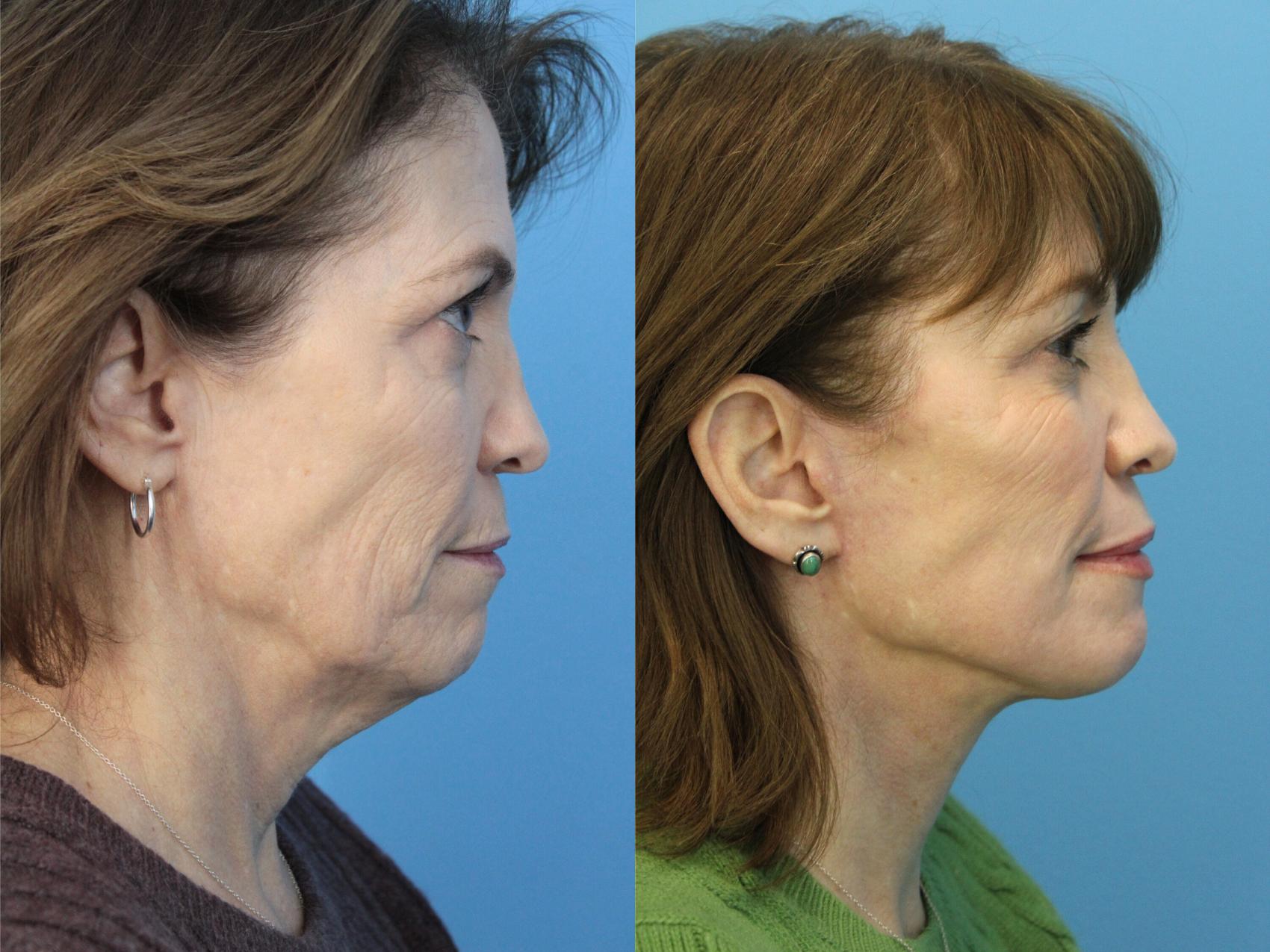 Before & After Laser Resurfacing Treatments Case 528 Right Side View in West Des Moines & Ames, IA