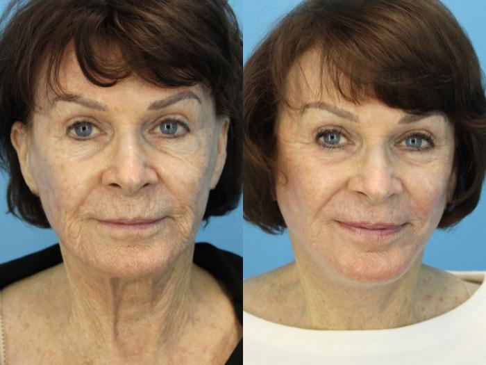Before & After Laser Resurfacing Treatments Case 534 Front View in West Des Moines & Ames, IA