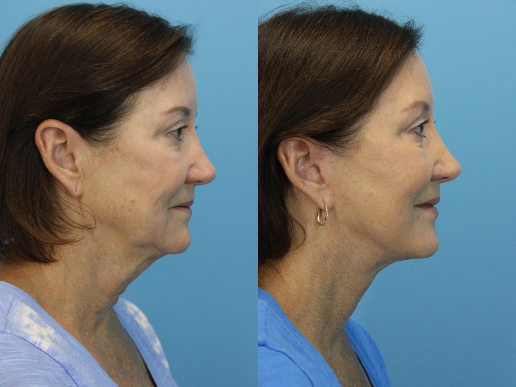 Before & After Facelift Case 562 Right Side View in West Des Moines & Ames, IA