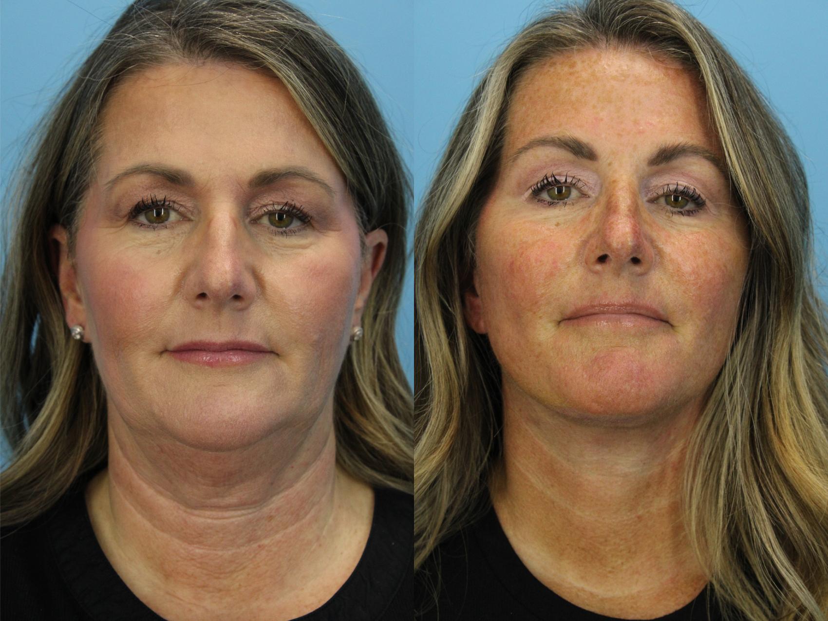 Before & After Facial Liposuction Case 563 Front View in West Des Moines & Ames, IA
