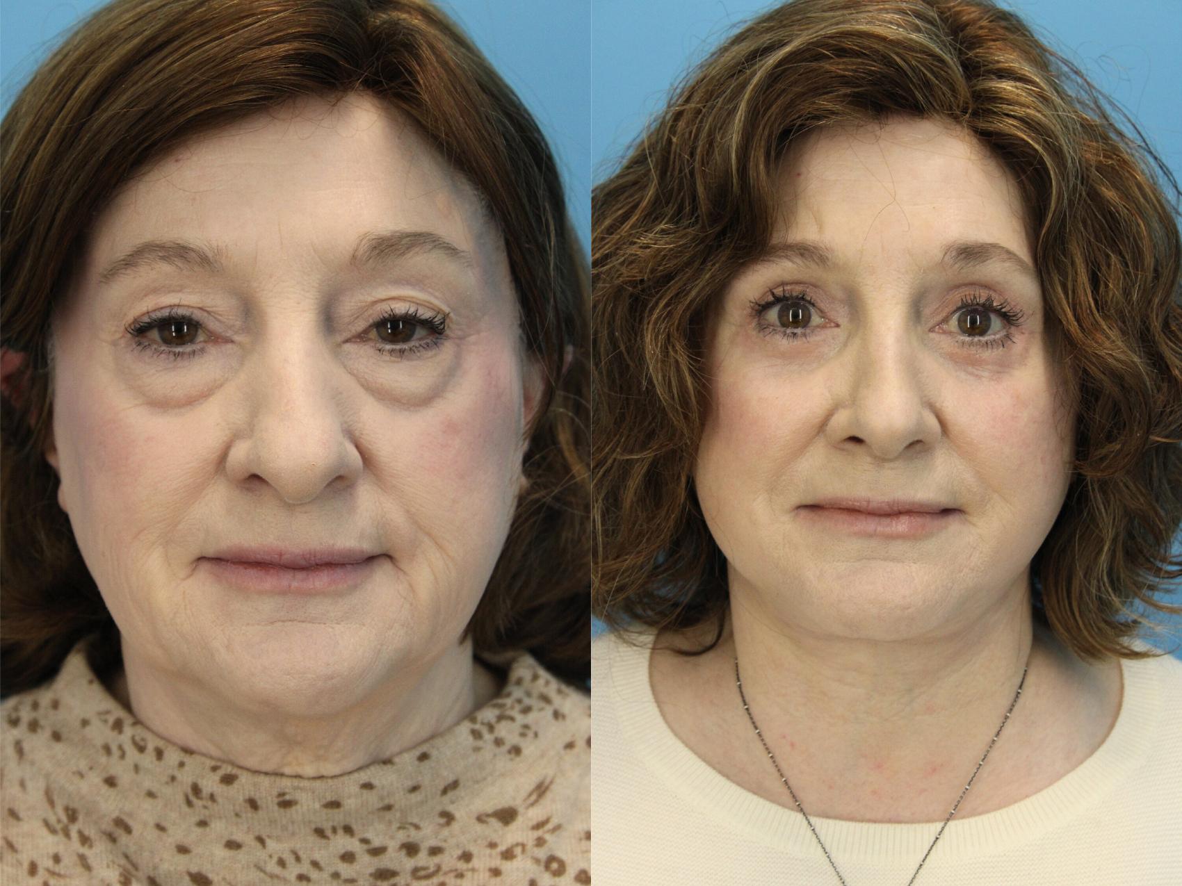 Before & After Facial Liposuction Case 572 Front View in West Des Moines & Ames, IA