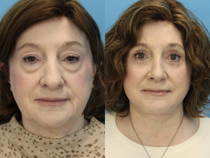 Before & After Facial Liposuction Case 572 Front View in West Des Moines & Ames, IA