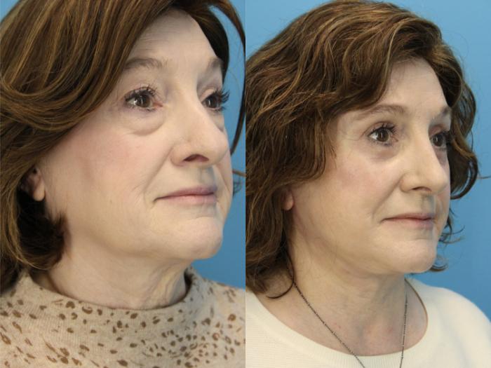 Before & After Facial Liposuction Case 572 Right Oblique View in West Des Moines & Ames, IA