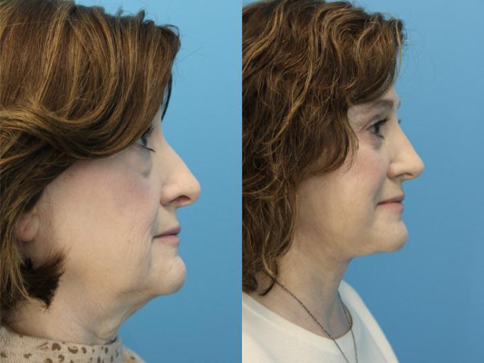 Before & After Facial Liposuction Case 572 Right Side View in West Des Moines & Ames, IA