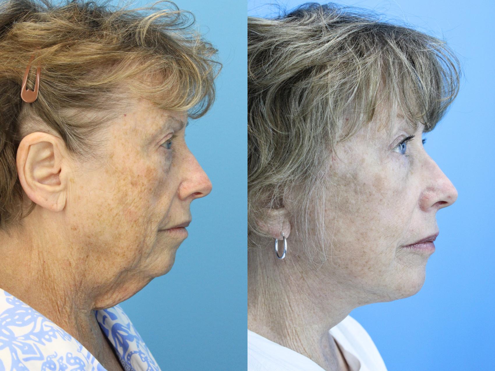 Before & After Facelift Case 636 Left Side View in West Des Moines & Ames, IA