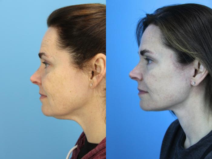 Before & After Facelift Case 658 Left Side View in West Des Moines & Ames, IA