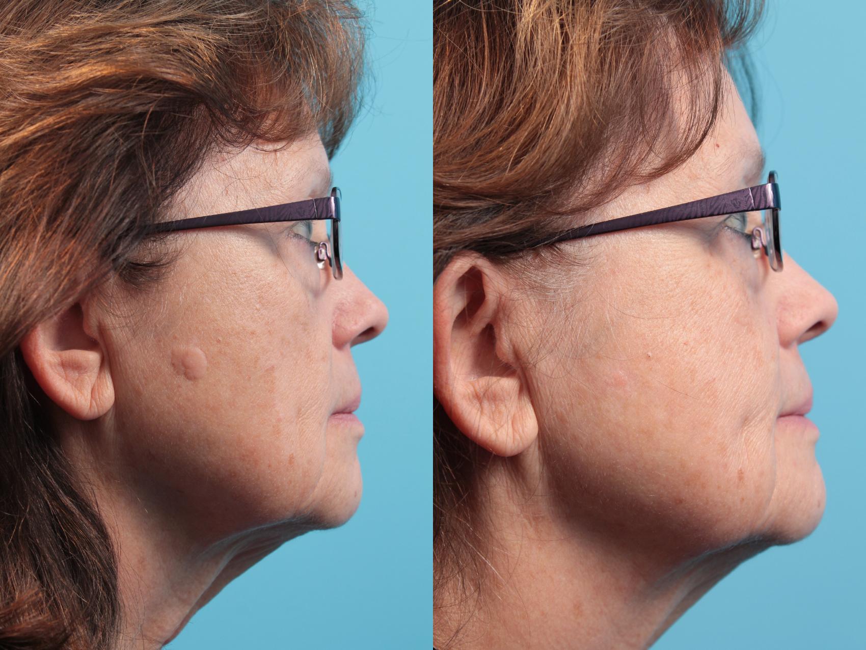 Before & After Laser Treatments Case 28 View #1 View in West Des Moines & Ames, IA