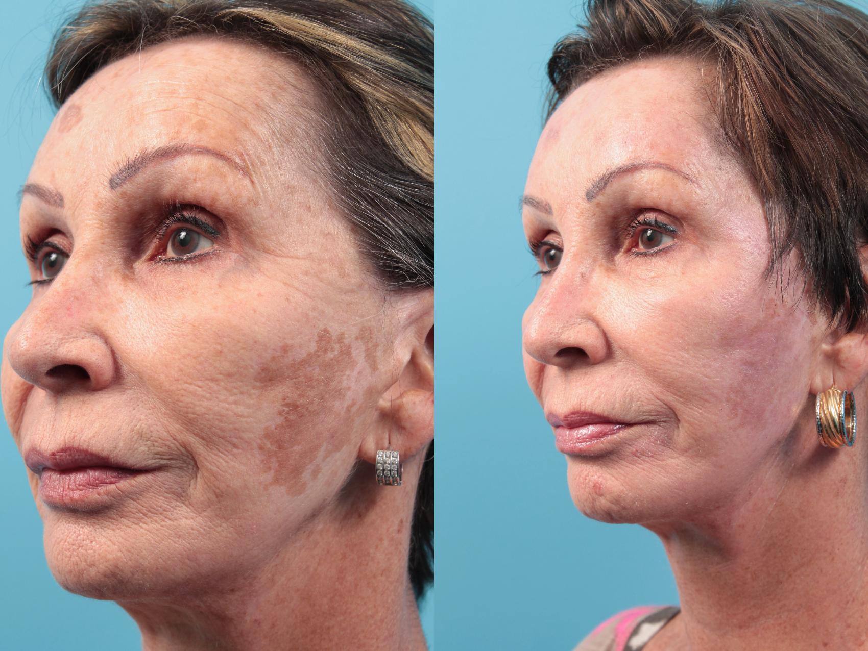 Before & After Laser Treatments Case 29 View #1 View in West Des Moines & Ames, IA