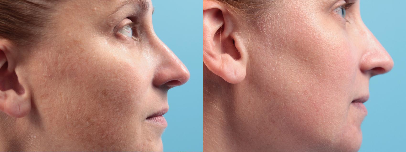 Before & After Laser Treatments Case 34 Right Side View in West Des Moines & Ames, IA