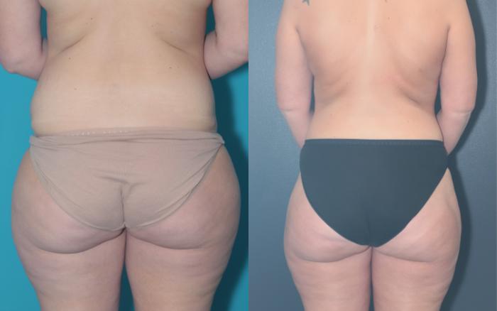 Before & After Liposuction/ Fat Transfer/ Brazilian Butt Lift Case 657 Back View in West Des Moines & Ames, IA