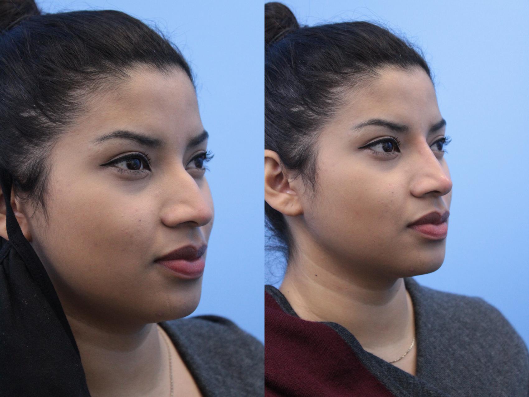 Non Surgical Rhinoplasty Before And After Pictures Case West Des