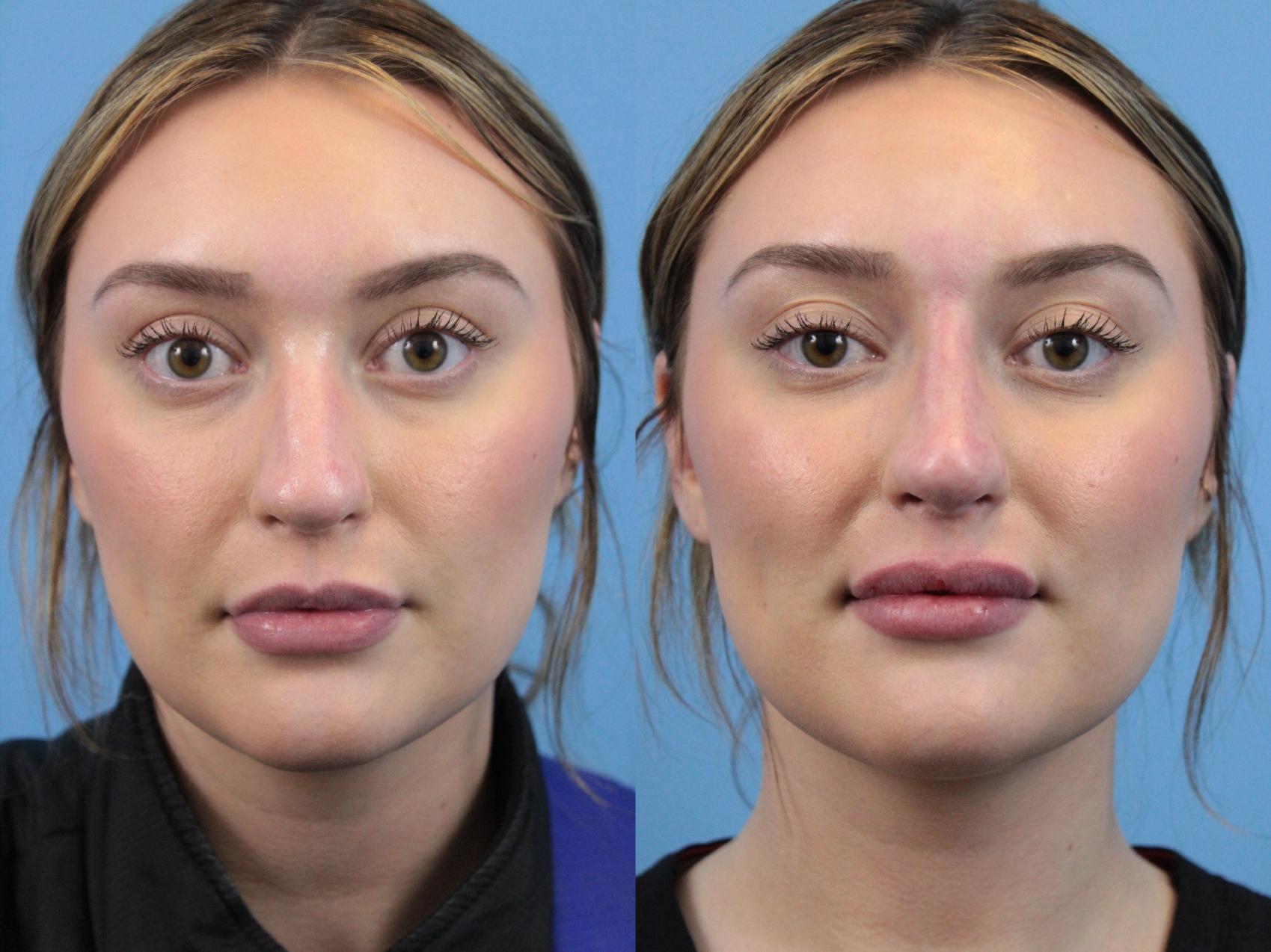 Before & After Non-Surgical Rhinoplasty Case 252 Front View in West Des Moines & Ames, IA