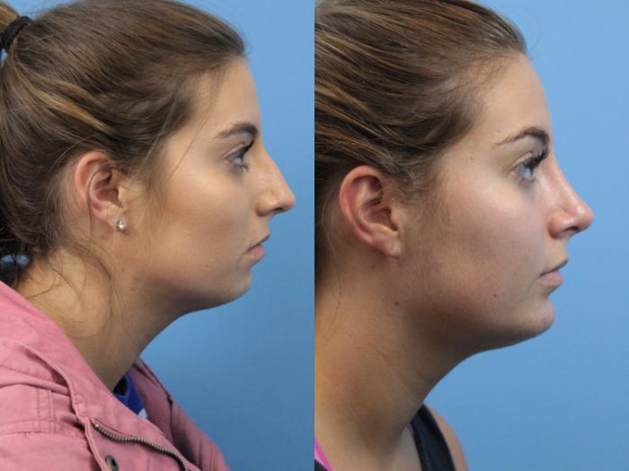 Before & After Chin Augmentation Case 146 View #1 View in West Des Moines & Ames, IA