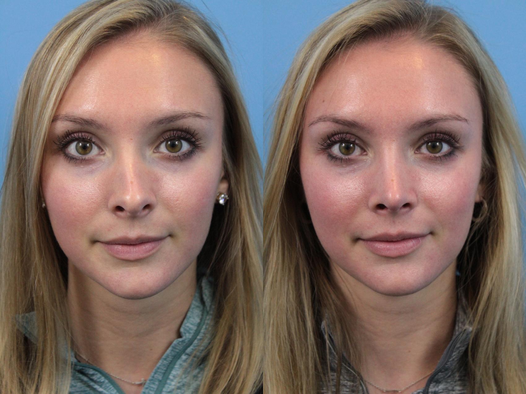 Before & After Rhinoplasty Case 176 View #1 View in West Des Moines & Ames, IA