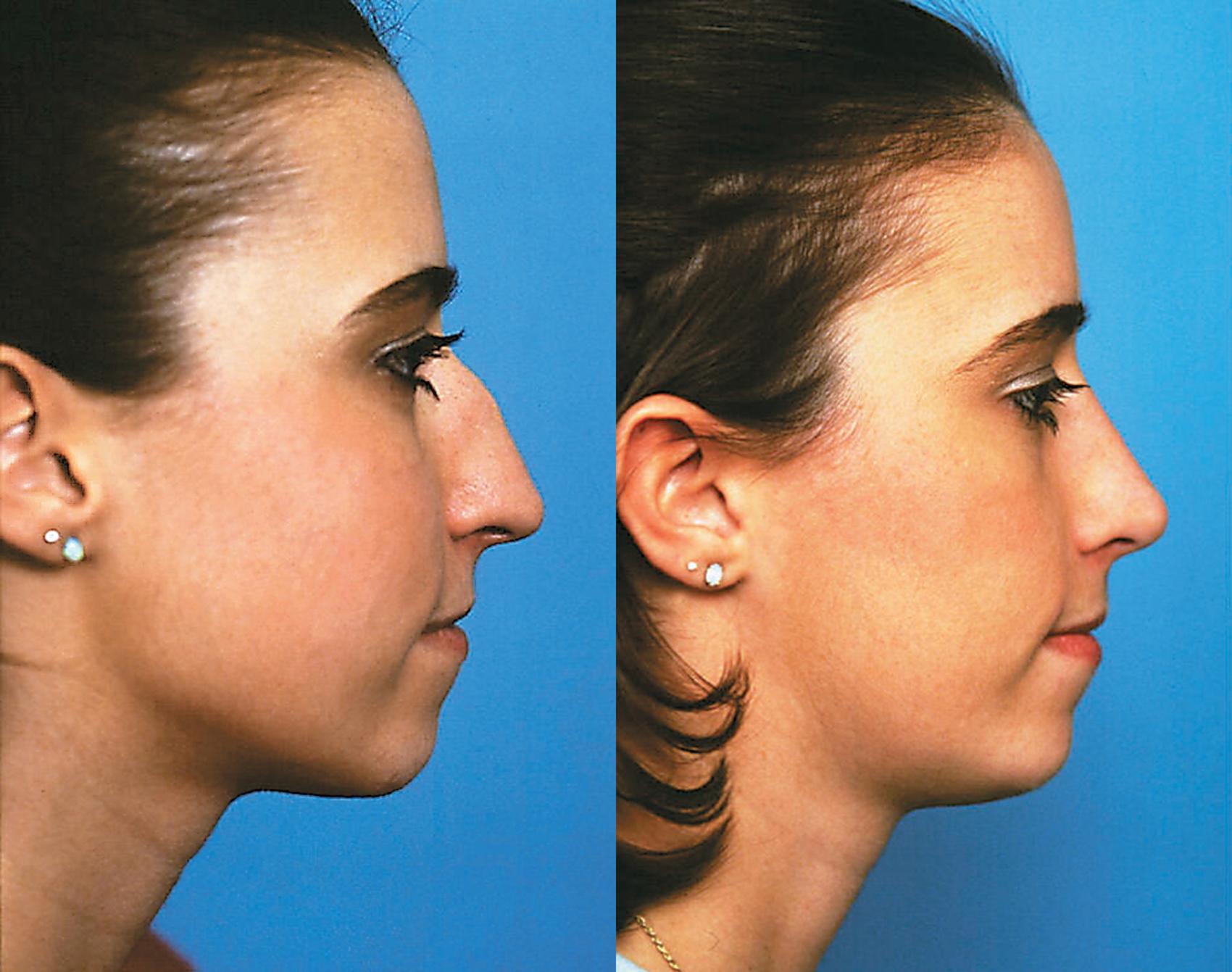 Before & After Rhinoplasty Case 2 View #1 View in West Des Moines & Ames, IA