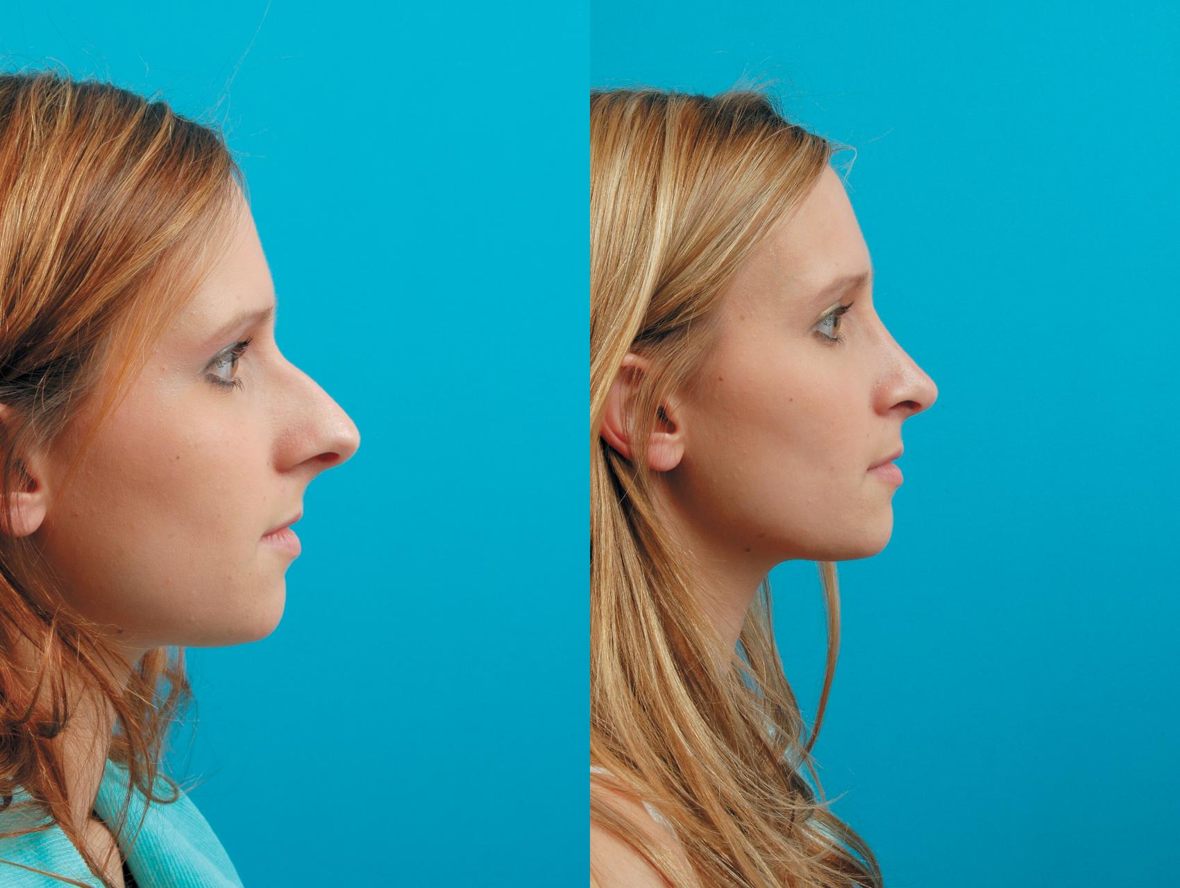 Before & After Rhinoplasty Case 3 View #1 View in West Des Moines & Ames, IA