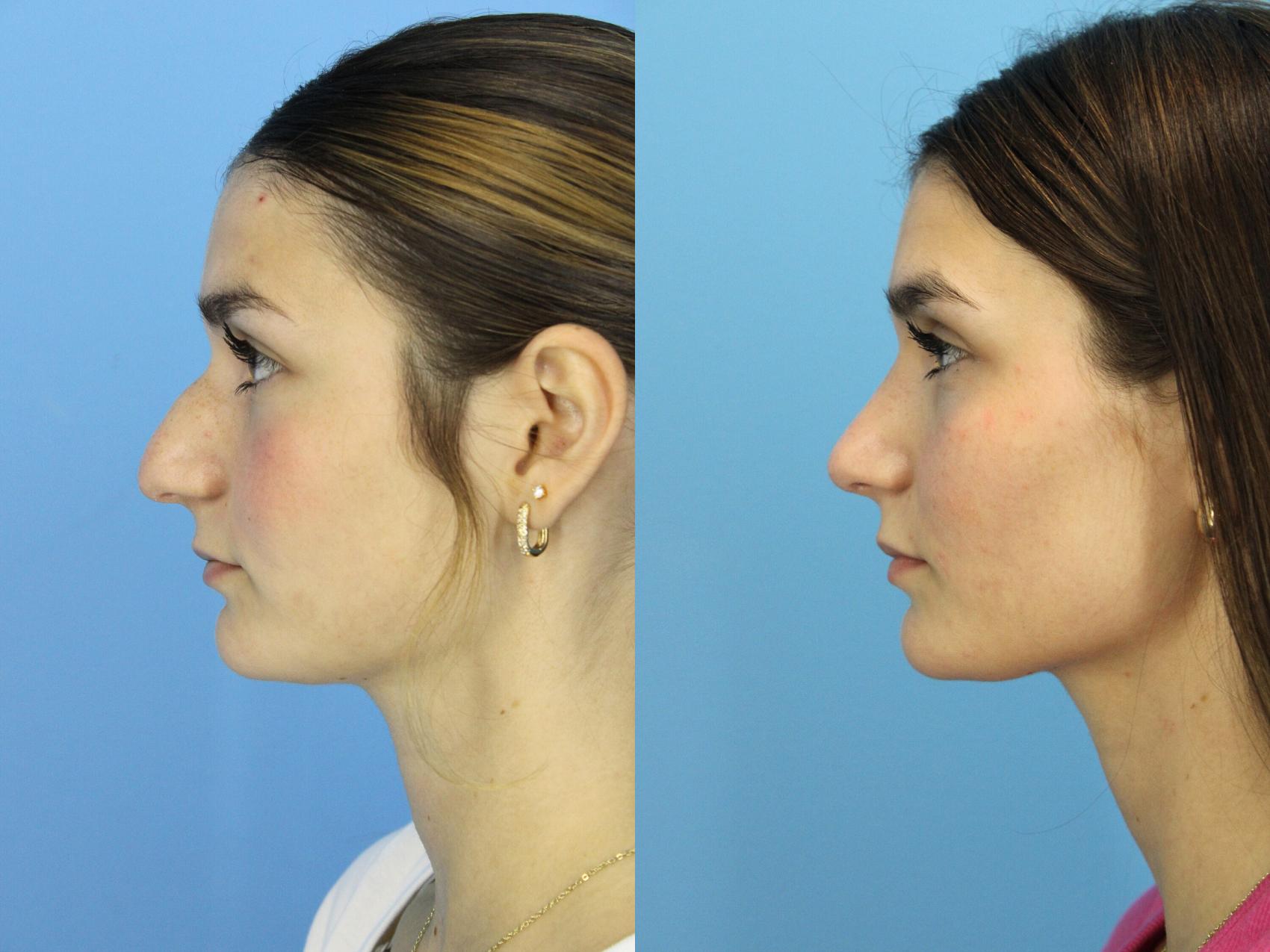 Before & After Rhinoplasty Case 522 Left Side View in West Des Moines & Ames, IA