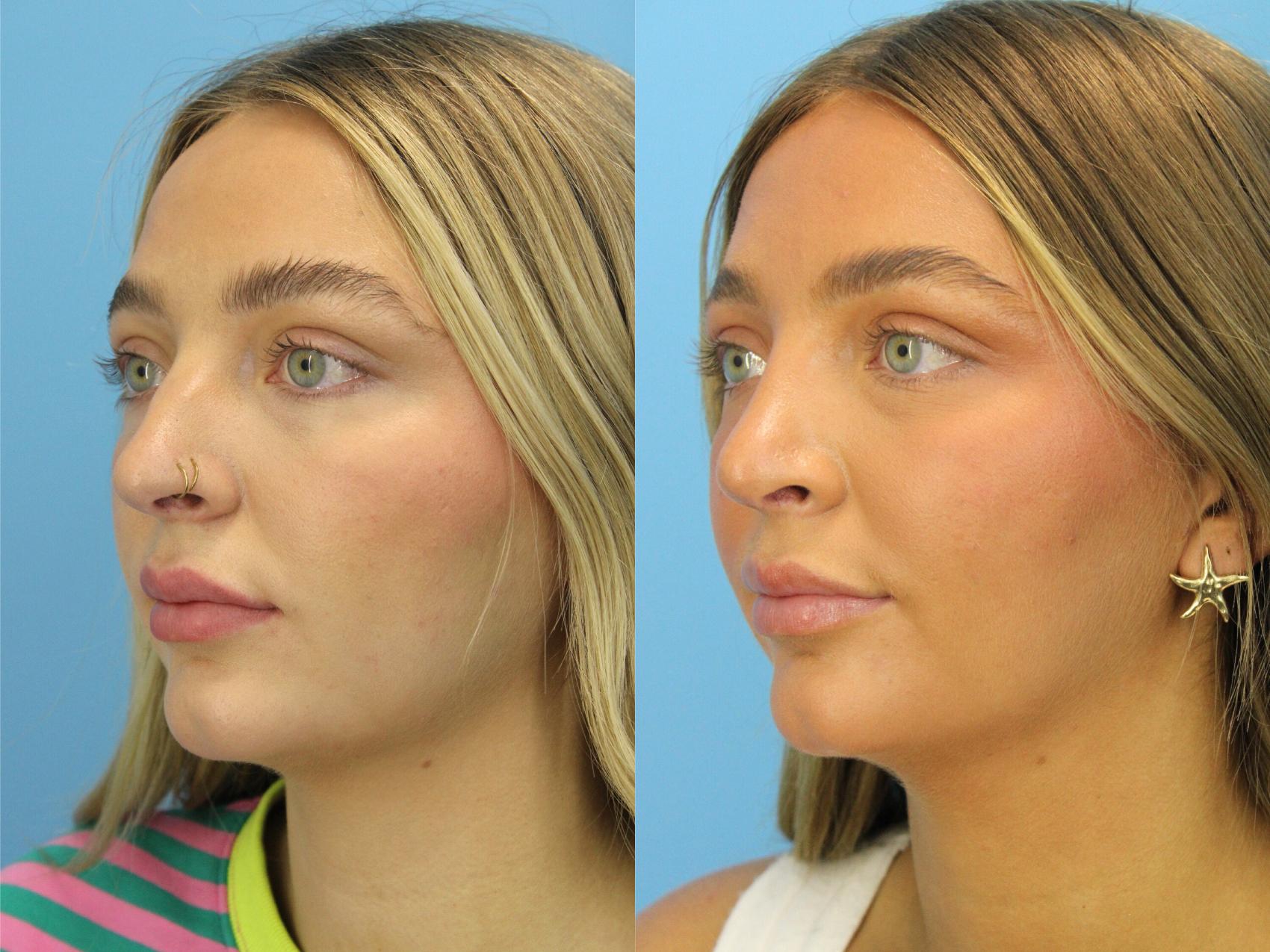 Before & After Rhinoplasty Case 551 Left Oblique View in West Des Moines & Ames, IA